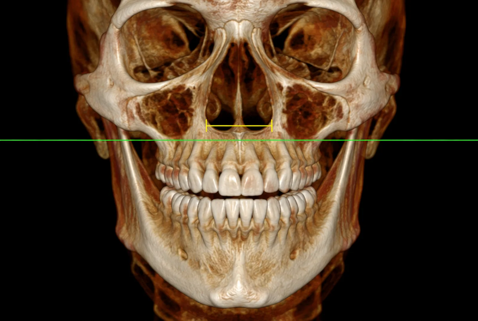 3D cone beam CT rendering of an adult skull from the front, with a measurement across the width of the nasal floor