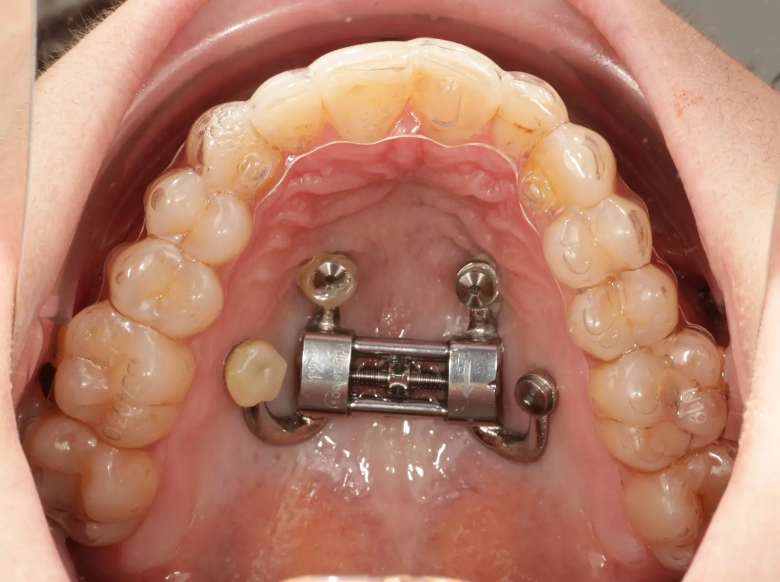 A DOMEzero palatal expander anchored in the roof of the mouth, worn with clear aligners