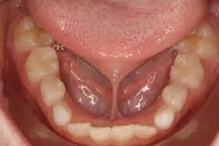 Close-up of a lifted tongue showing a short, tight frenulum connecting it to the floor of the mouth