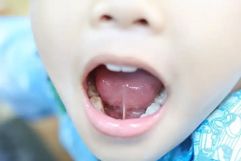 A child's lifted tongue showing the frenulum during a tongue-tie evaluation at Toothpillow Breathing & Sleep Center in Draper, Utah