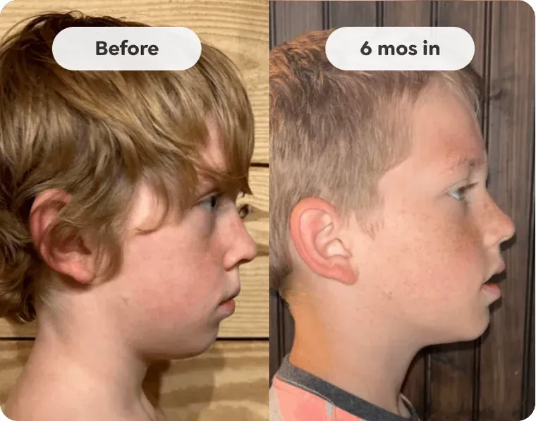 Side profile of a child before Toothpillow early growth care and six months in, at Toothpillow Breathing and Sleep Center in Draper, Utah