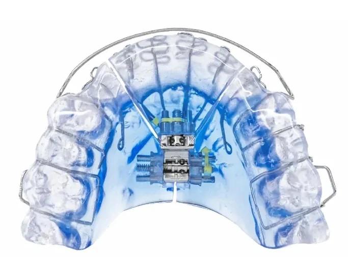 A Vivos DNA appliance, the removable arch development appliance used in Vivos treatment at Toothpillow Breathing & Sleep Center in Draper, Utah